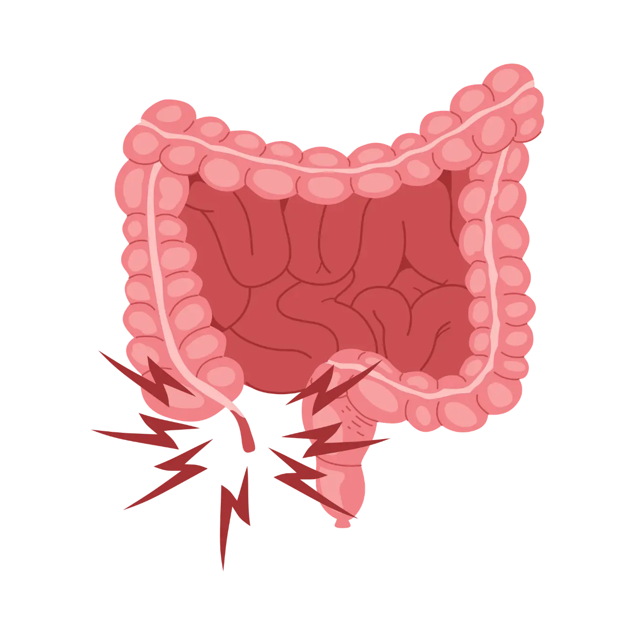 Apendicitis