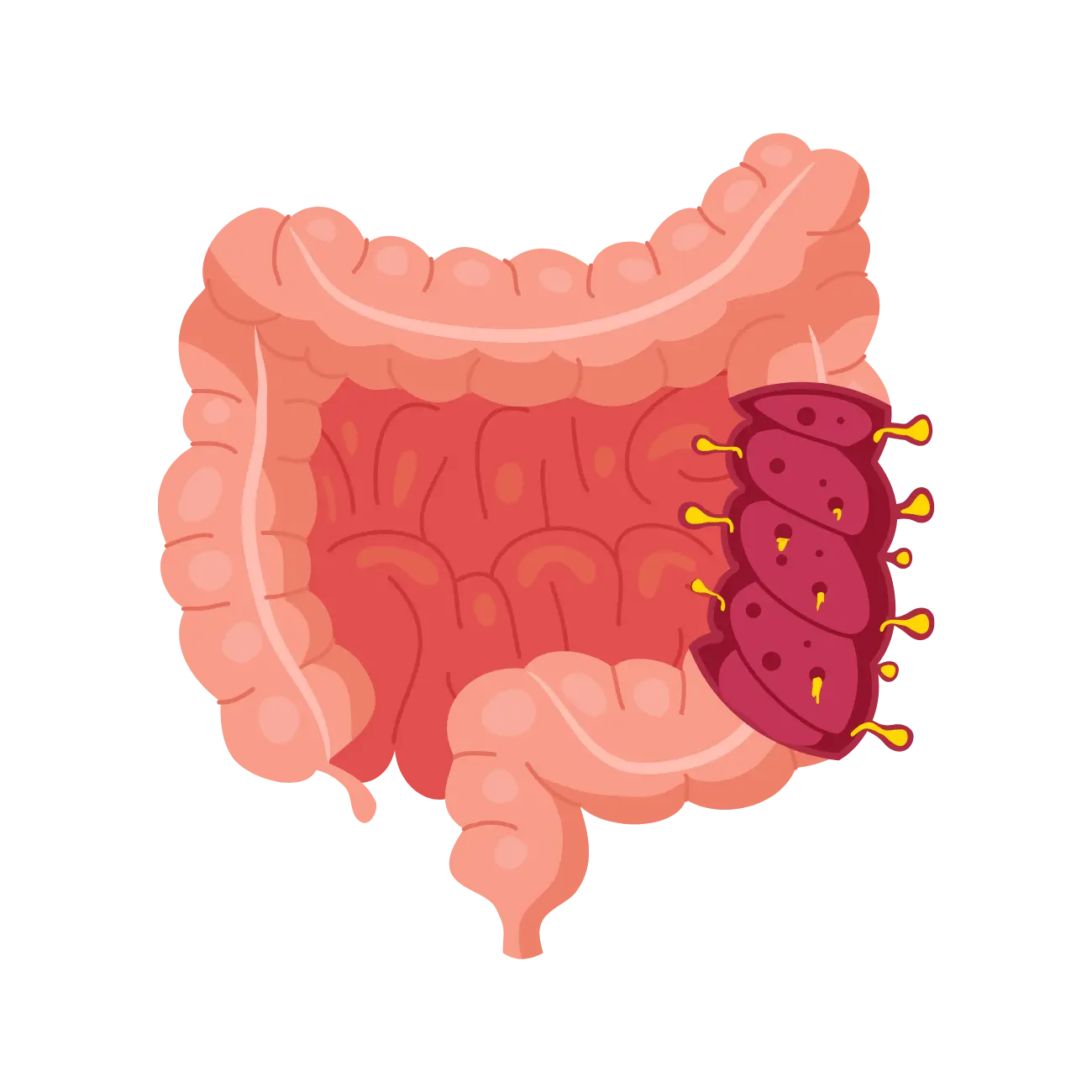 Diverticulitis