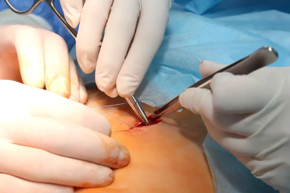 Hernia Abierta