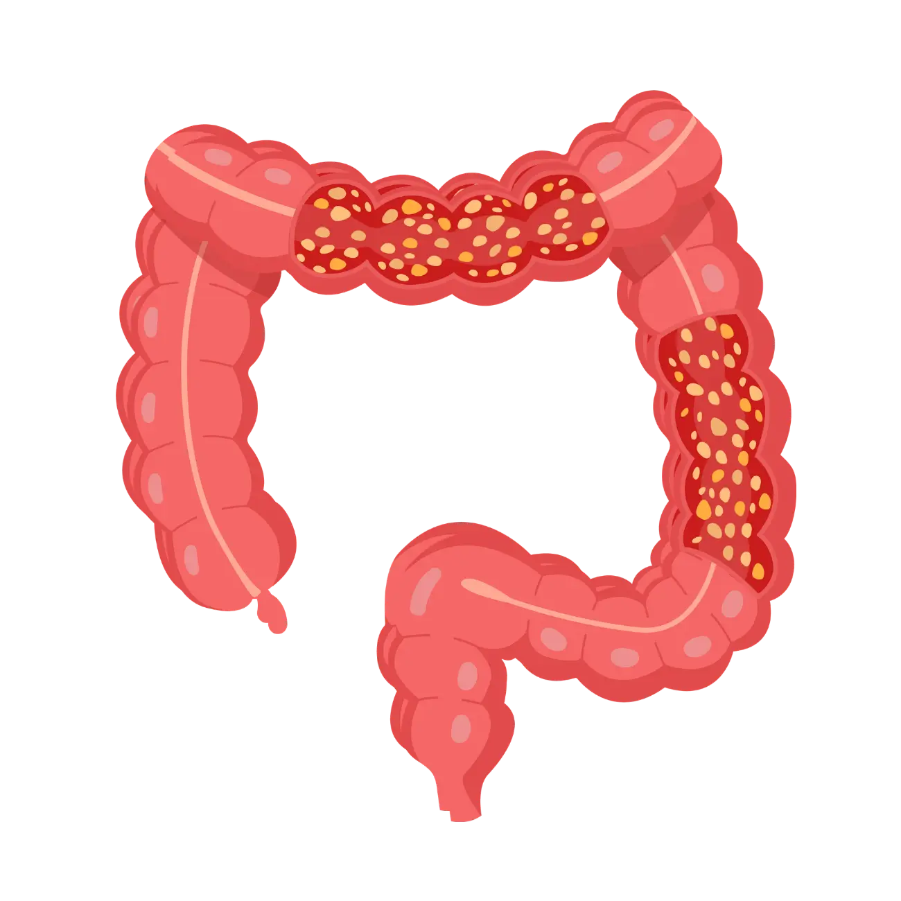 Colitis